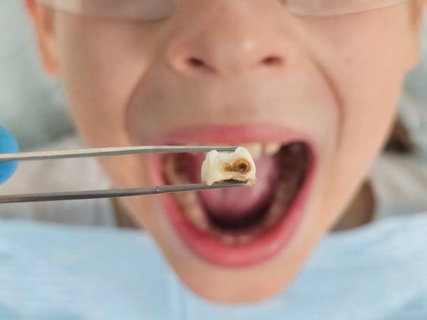 Best Walk-In Emergency Dental Services in Thibodaux, LA